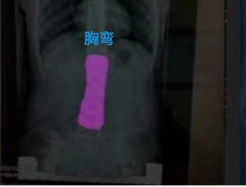 脊椎侧弯胸弯识别
