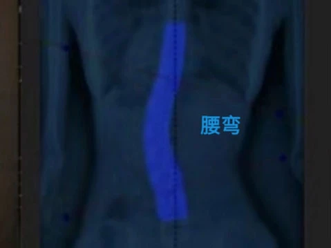 脊椎侧弯腰弯识别